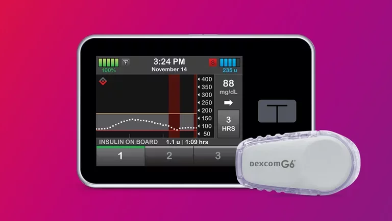 Desafíos potenciales de la terapia con bomba de insulina