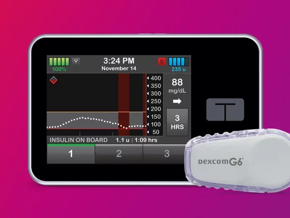 Desafíos potenciales de la terapia con bomba de insulina